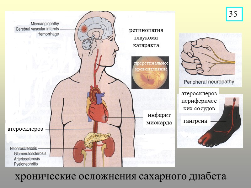 хронические осложнения сахарного диабета инфаркт миокарда атеросклероз атеросклероз периферических сосудов гангрена ретинопатия глаукома катаракта